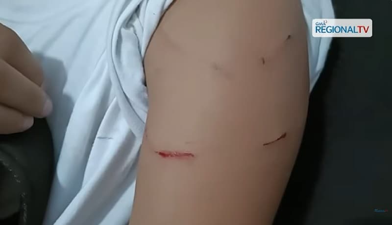 Estudyanteng Grade 7, nasugatan matapos umanong paluin ng guro sa Bacolod City